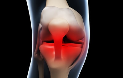 人工膝関節置換術のデメリット