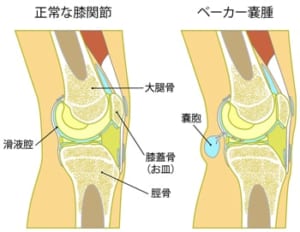 正常な膝関節とベーカー嚢腫ができた膝の比較図