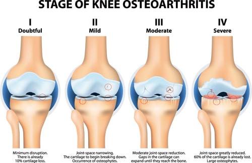 変形性膝関節症のK-L分類