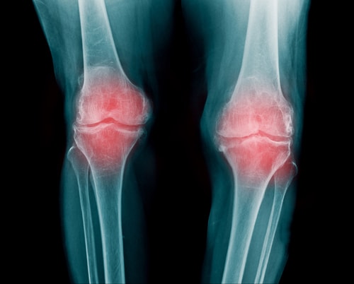 変形性膝関節症に対するPRP治療の効果