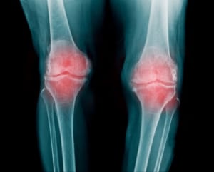 変形性膝関節症の原因のひとつO脚