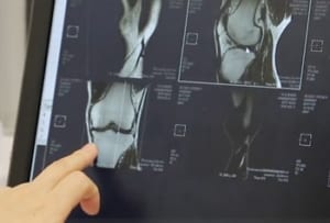 変形性膝関節症の名医の診断報告