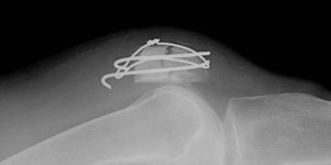 膝蓋骨骨折の手術