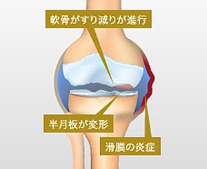 変形性膝関節症の炎症