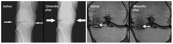 膝関節のレントゲンとMRI画像