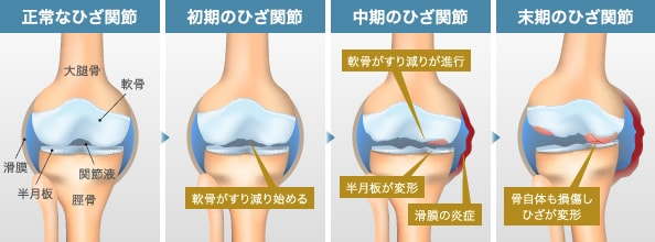 変形性膝関節症の進行