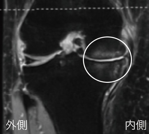 MRI検査で確認された膝関節浮腫