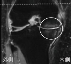 MRIで確認された膝関節の浮腫